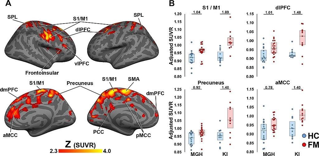 1024px-Fibromyalgia_Glial_Activation_Voxelwise_group_differences_in_11CPBR28_SUVR_A._Fig._2.jpg