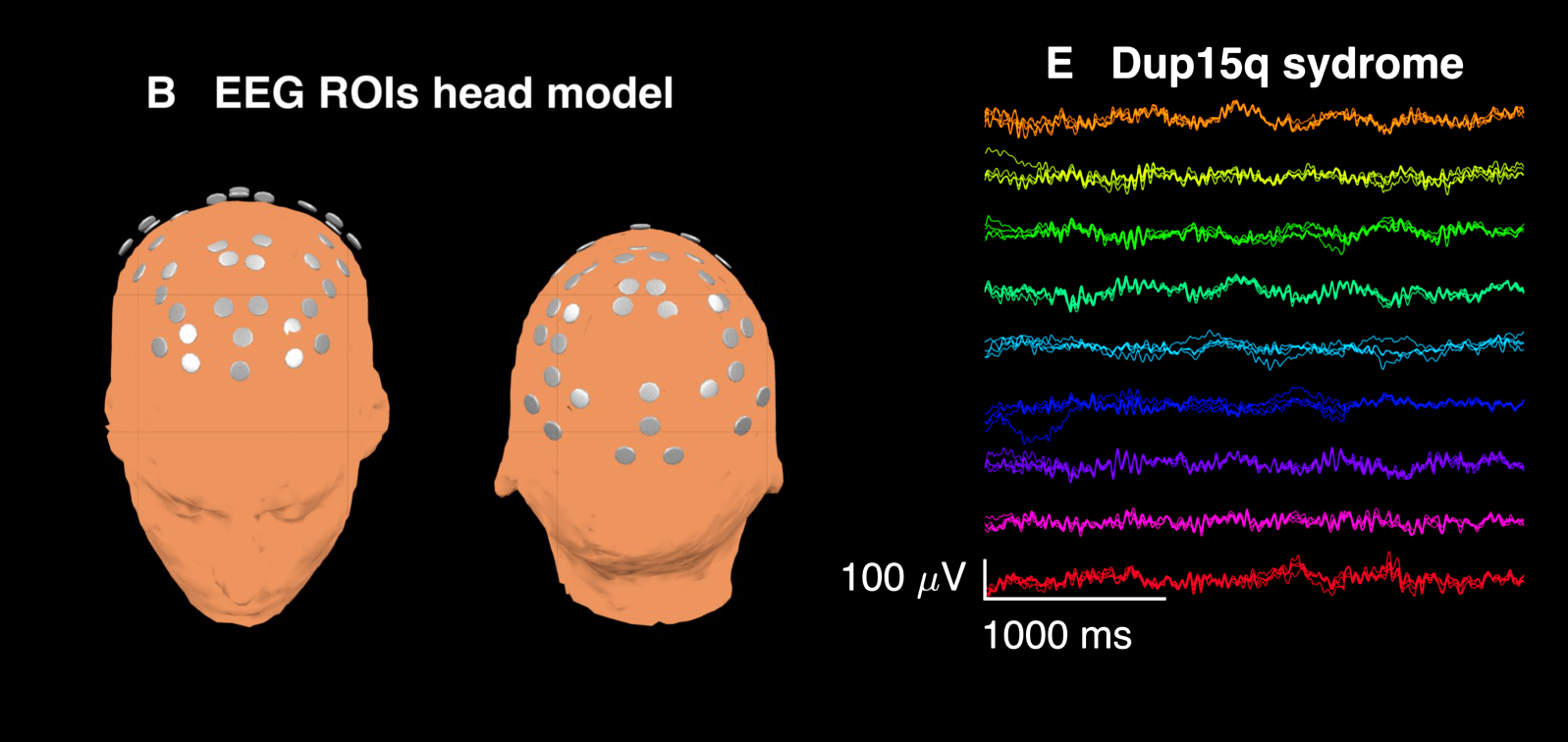 Dup15q_EEG_signature.png