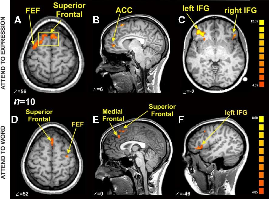 FMRI_BOLD_activation_in_an_emotional_Stroop_task.jpeg